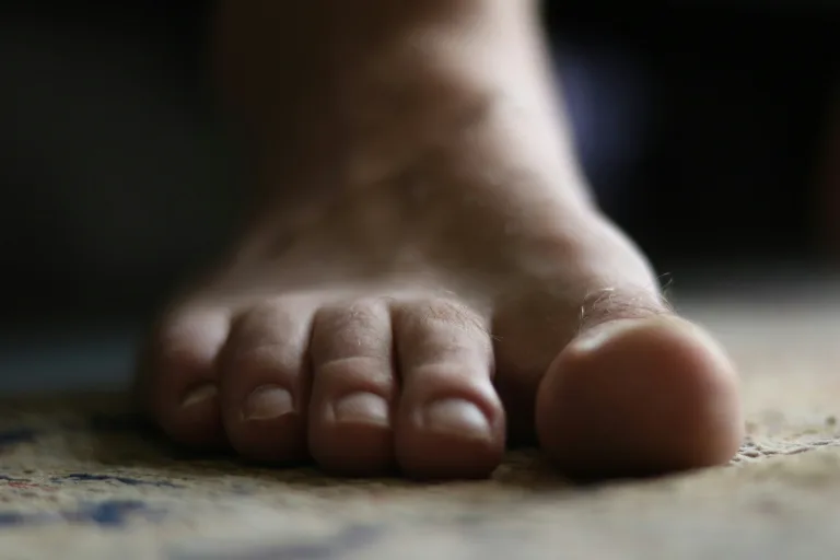 Understanding Gout: Causes, Diet & Management
